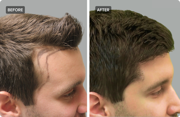 HairTransplant_01